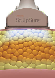 SculpSure - Holistic Health and Laser Hair Removal Clinic